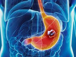 Дефіцит вітаміну В12 пов’язаний із п’ятикратним збільшенням ризику раку шлунка